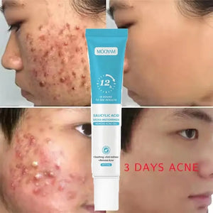 🧴 AKUNADO – Anti-Acné- Conçue pour les béninois .