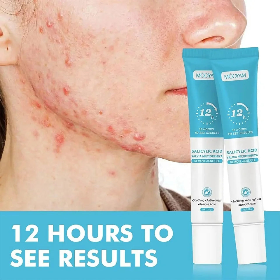 🧴 AKUNADO – Anti-Acné- Conçue pour les béninois .