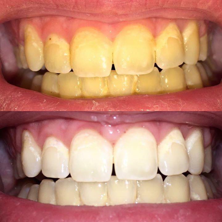 Dentifrice Blanchissant Akunado SP4