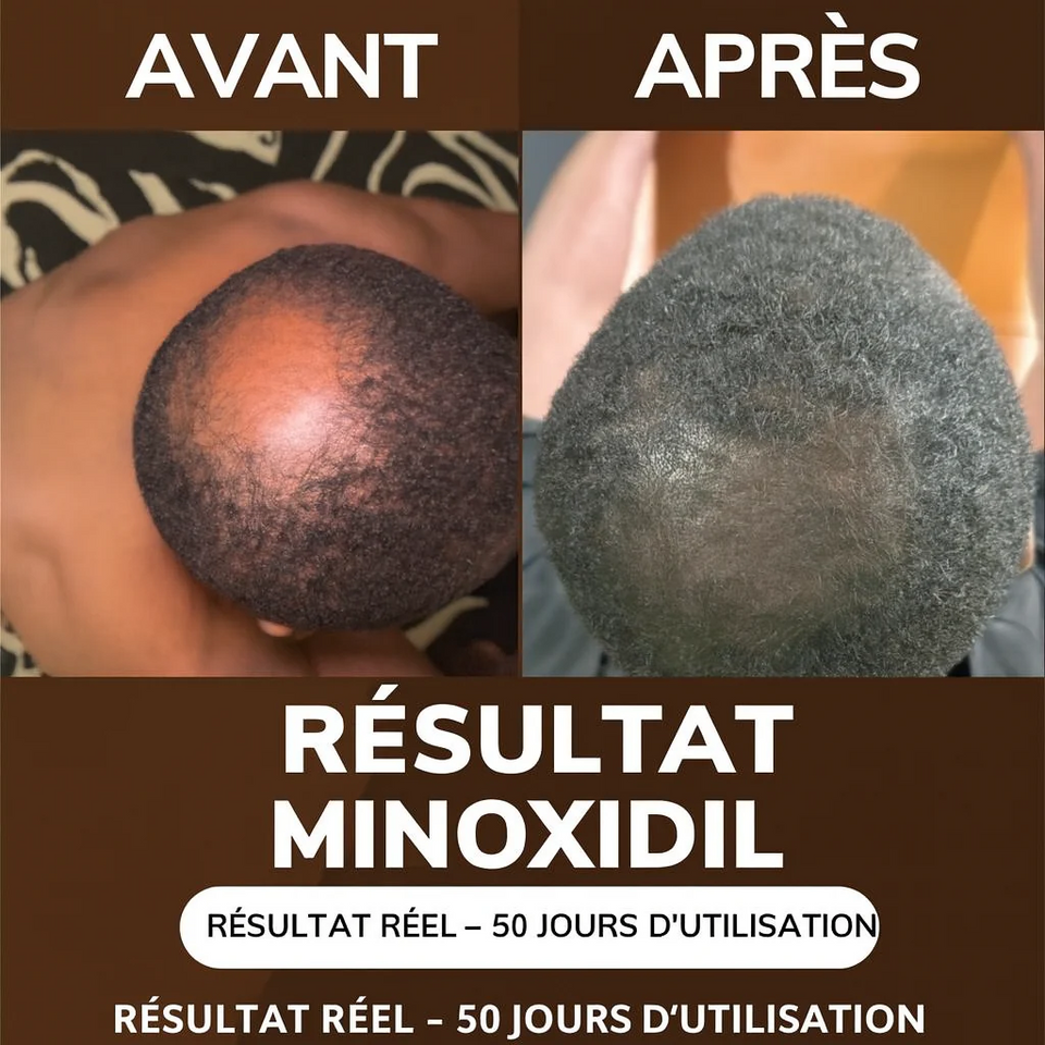 Minoxidil  PACK POUSSE BARBE CHEVEUX – AKUNADO