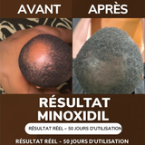 Minoxidil  PACK POUSSE BARBE CHEVEUX – AKUNADO